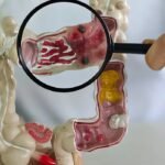 Entenda por que doenças inflamatórias intestinais crescem