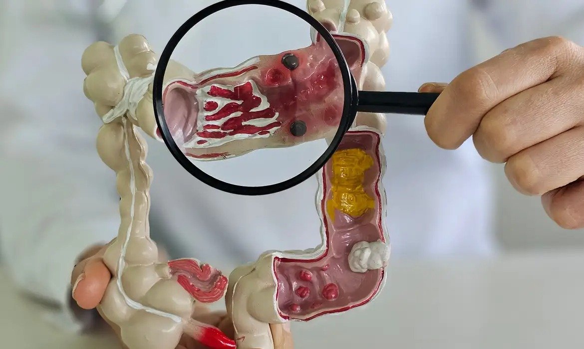 Entenda por que doenças inflamatórias intestinais crescem